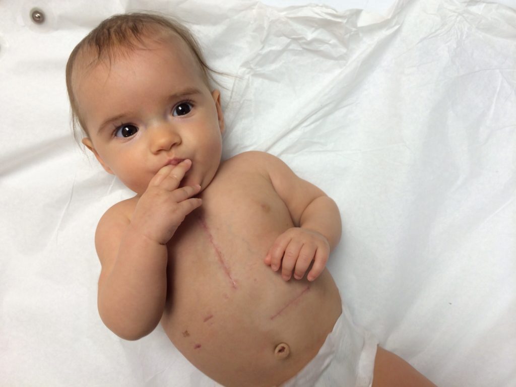 child with pacemaker