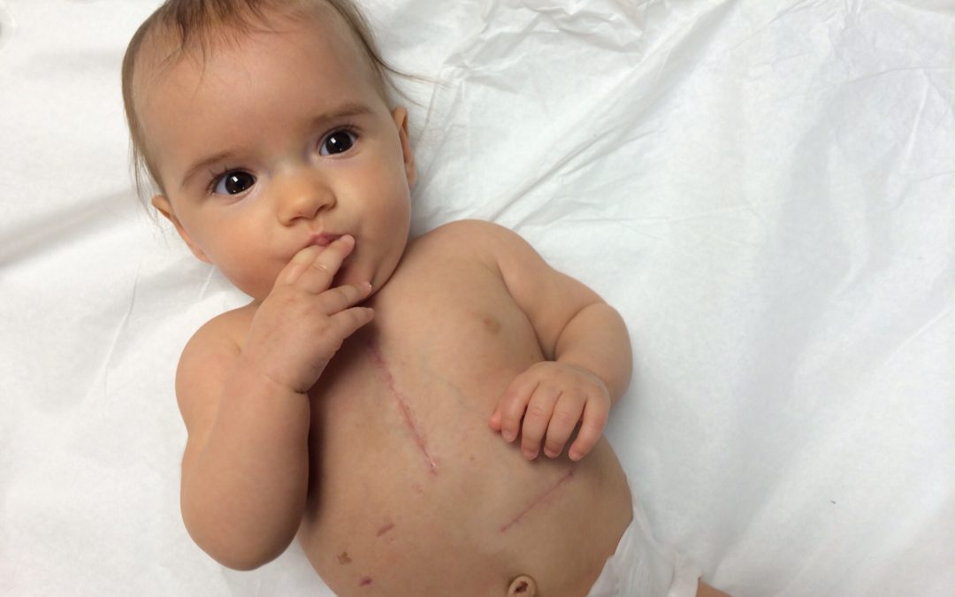 child with pacemaker
